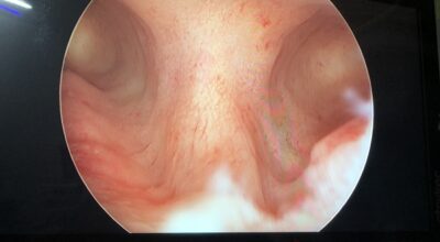 histeroscopy